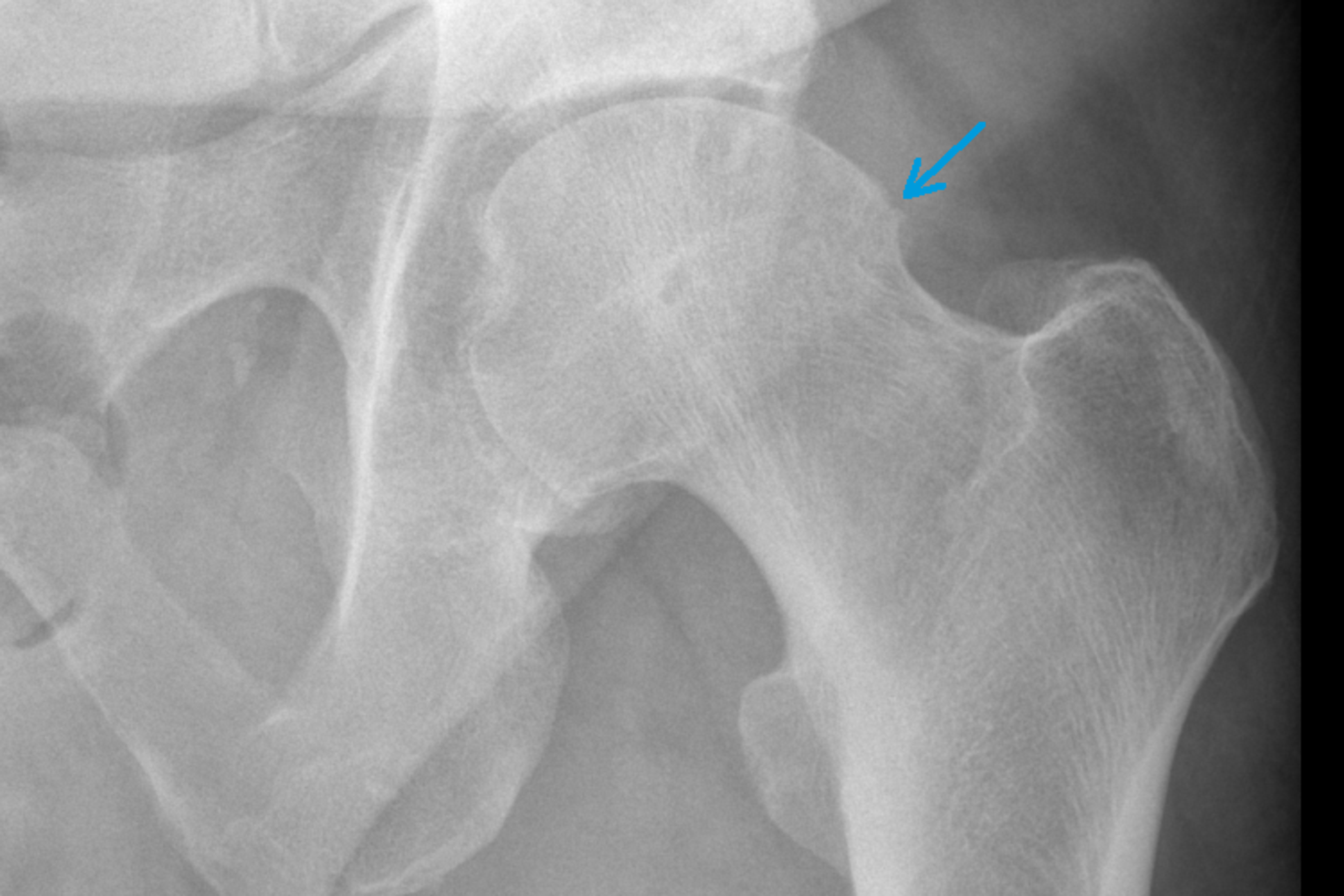 37+ Mrt bilder impingement huefte , Hüfte und Oberschenkel DietrichBonhoefferKlinikum