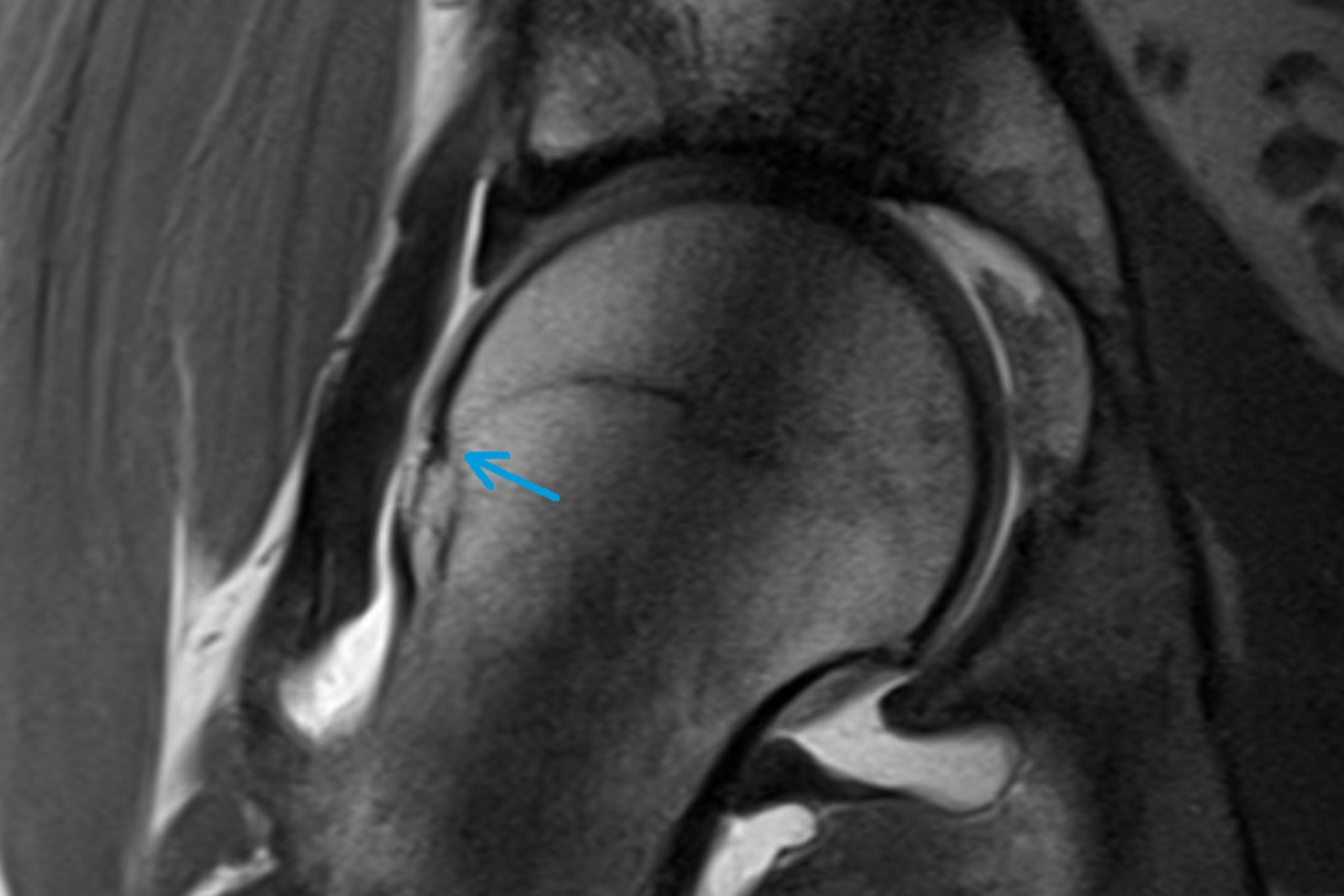 36++ Mrt bilder impingement huefte , Hüfte und Oberschenkel DietrichBonhoefferKlinikum