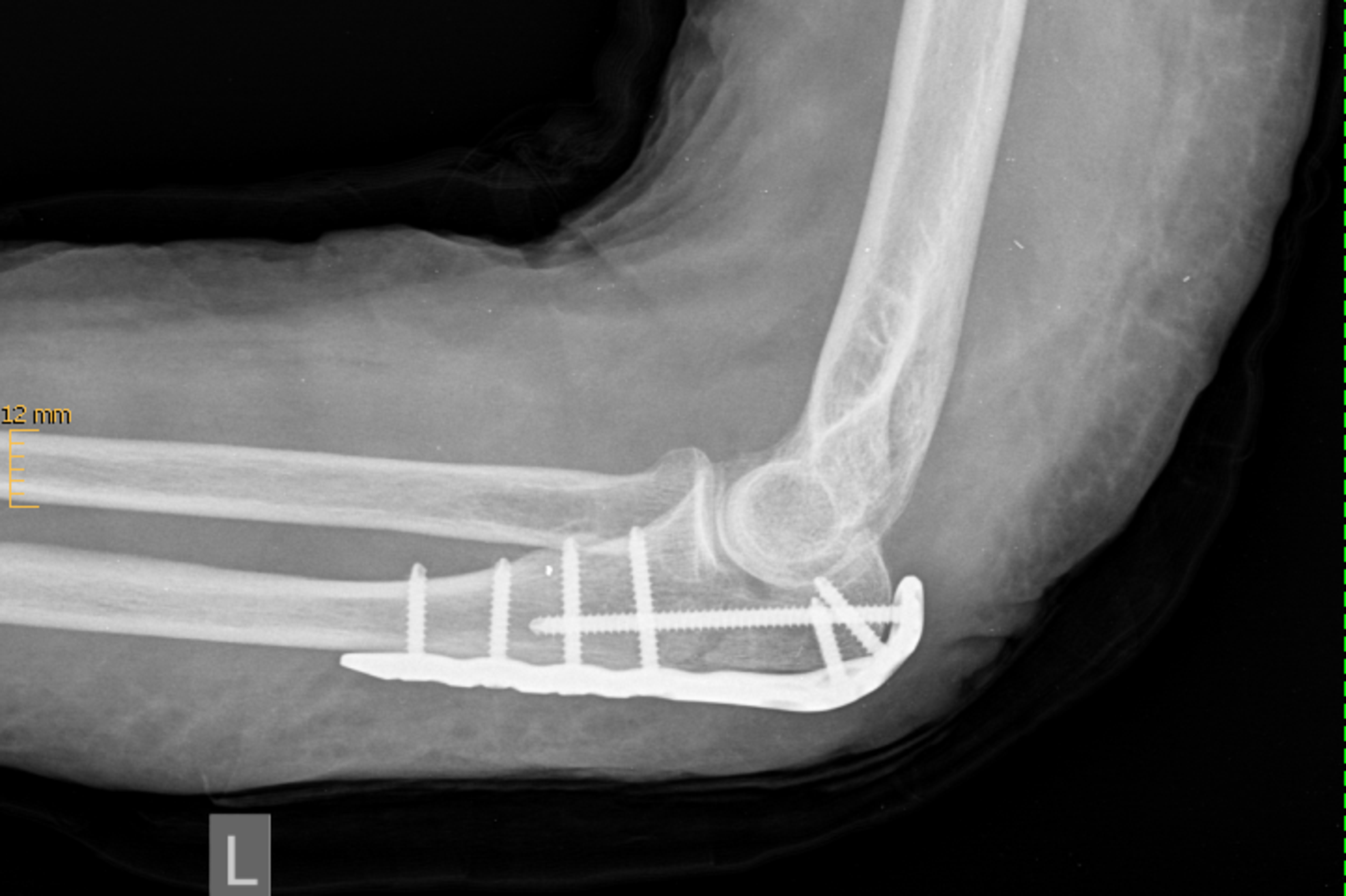 stützstrumpf ellenbogen